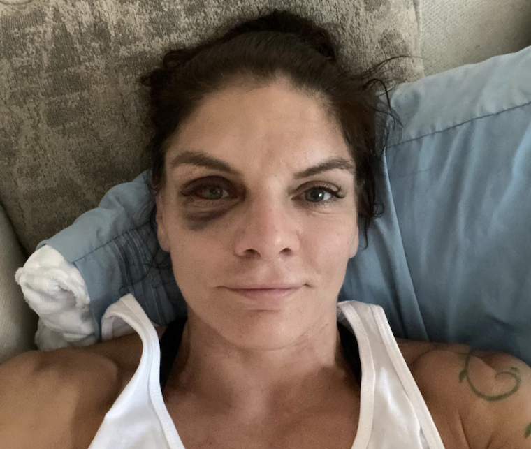 UFC: Lauren Murphy Fires Back at Daniel Cormier Corner Critcism lauren murphy black eye ufc