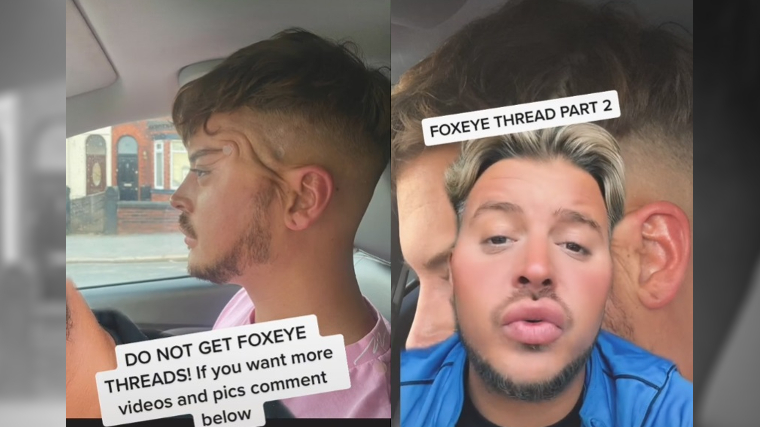 It’s Viral: Big Brother UK Alum Shares “Fox Eyes Thread” Nightmare Aftermath on TikTok It’s Viral: Big Brother UK Alum Shares “Fox Eyes Thread” Nightmare Aftermath on TikTok