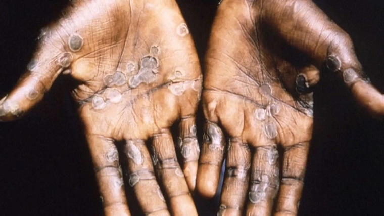 The World Health Organization is Currently Investigating 50 Monkeypox Cases in the U.S, Canada, Australia, and Europe…More Reports Expected The World Health Organization in Currently Investigating 50 Monkeypox Cases in the U.S, Canada, Australia, and Europe...More Reports Expected